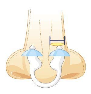 Filtro Nasal Nosk 2 Unidades TALLA GRANDE Con Cajita